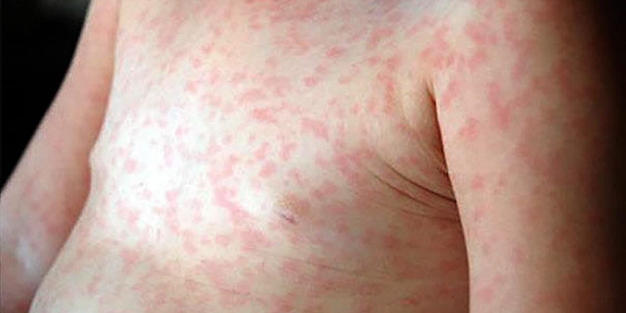 DECLARAN ALERTA EPIDEMIOLÓGICA NACIONAL POR NUEVO CASO POSITIVO DE SARAMPIÓN EN ORURO