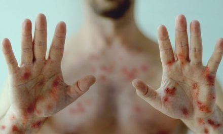 SALUD ADVIERTE QUE LA VIRUELA SÍMICA PUEDE LLEGAR AL PAÍS EN CUALQUIER MOMENTO