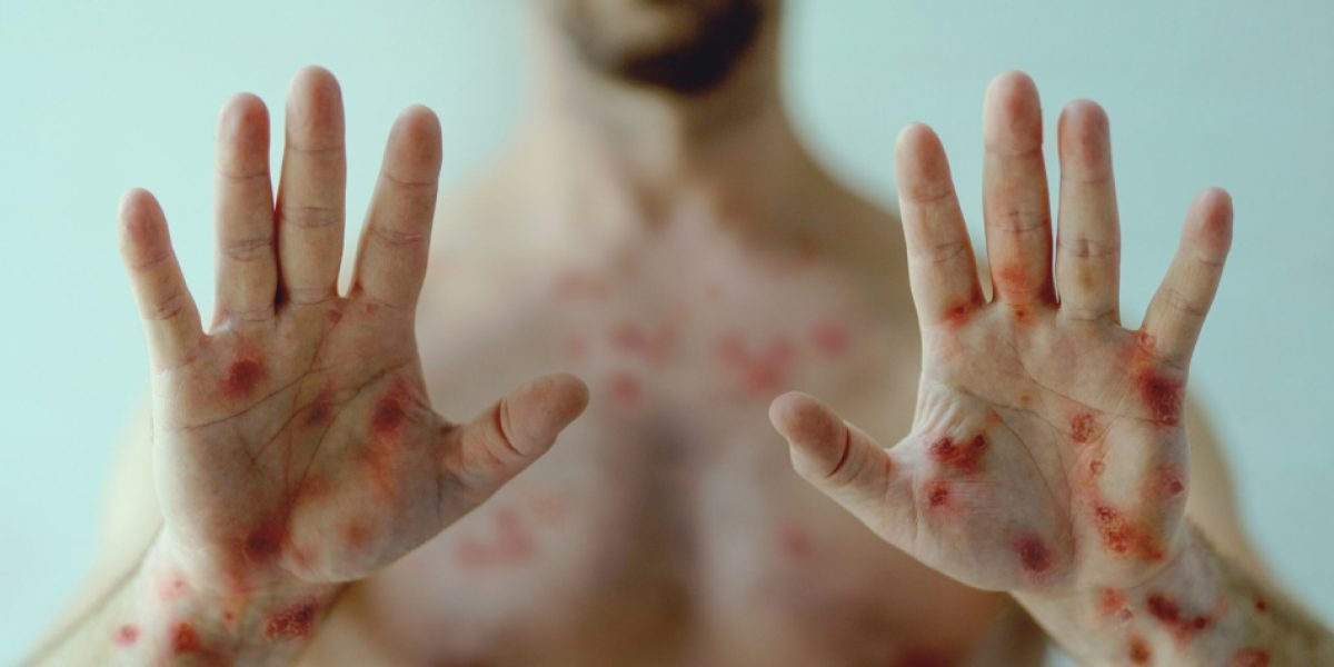 SALUD ADVIERTE QUE LA VIRUELA SÍMICA PUEDE LLEGAR AL PAÍS EN CUALQUIER MOMENTO