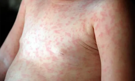 SALUD REPORTA 50 CASOS DE SARAMPIÓN; LA PAZ Y POTOSÍ REGISTRAN SUS PRIMEROS CONTAGIOS