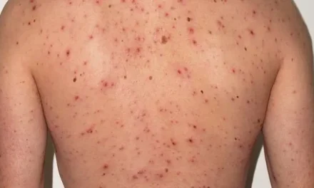 SUBEN A 23 LOS PACIENTES CON SARAMPIÓN EN SANTA CRUZ