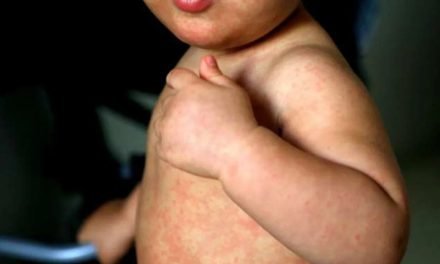 REPORTAN CASOS DE SARAMPIÓN EN MUNICIPIO DE CHARAGUA