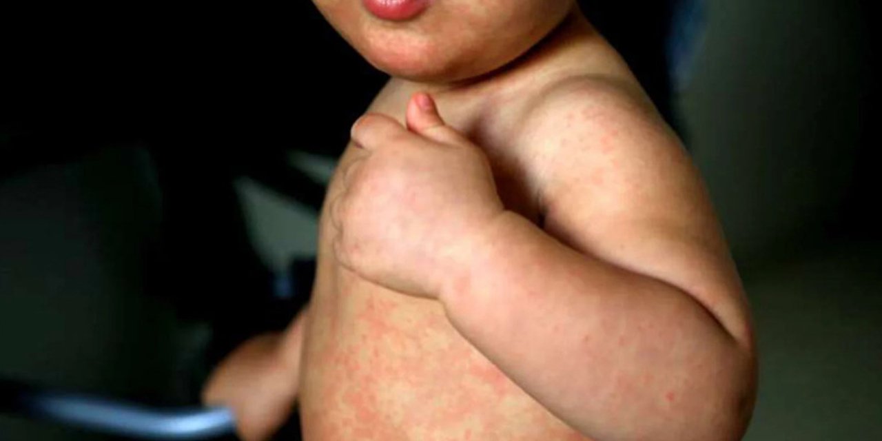 REPORTAN CASOS DE SARAMPIÓN EN MUNICIPIO DE CHARAGUA